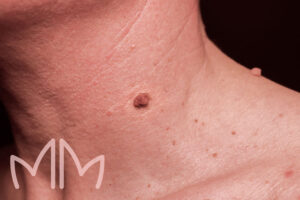 Tratamento de Acrocórdons Pescoço em Santo Antônio da Platina e região. Dra. Mariana Magalhães Dermatologista