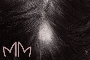 Tratamento de Alopecia Areata em Santo Antônio da Platina e região. Dra. Mariana Magalhães Dermatologista