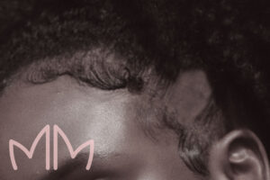 Tratamento de Alopecia de tração em Santo Antônio da Platina e região. Dra. Mariana Magalhães Dermatologista