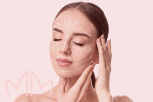 Aplicação de Bioestimuladores de Colágeno em Santo Antônio da Platina e região. Dra. Mariana Magalhães Dermatologista