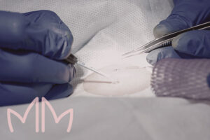 Tratamento de Biopsia de pele em Santo Antônio da Platina e região. Dra. Mariana Magalhães Dermatologista