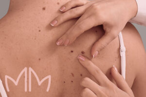 Tratamento Câncer de pele em Santo Antônio da Platina e região. Dra. Mariana Magalhães Dermatologista