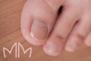 Tratamento de Cantoplastia (Unha Encravada) em Santo Antônio da Platina e região. Dra. Mariana Magalhães Dermatologista