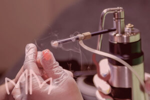 Procedimento de Crioterapia em Santo Antônio da Platina e região. Dra. Mariana Magalhães Dermatologista