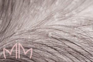 Tratamento de Dermatite seborreica couro cabeludo em Santo Antônio da Platina e região. Dra. Mariana Magalhães Dermatologista