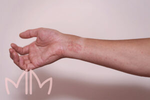 Tratamento Dermatites em Santo Antônio da Platina e região. Dra. Mariana Magalhães Dermatologista