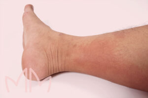 Tratamento Dermatites Ocre em Santo Antônio da Platina e região. Dra. Mariana Magalhães Dermatologista