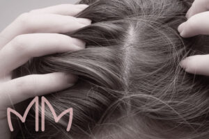 Tratamento de Eflúvio telógeno em Santo Antônio da Platina e região. Dra. Mariana Magalhães Dermatologista