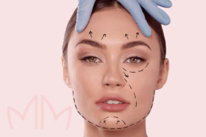 Aplicação de Fios de PDO para produção de colágeno em Santo Antônio da Platina e região. Dra. Mariana Magalhães Dermatologista