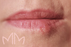 Tratamento de Herpes em Santo Antônio da Platina e região. Dra. Mariana Magalhães Dermatologista