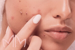 Tratamento de Infecções da pele por Bactérias ou Vírus em Santo Antônio da Platina e região. Dra. Mariana Magalhães Dermatologista