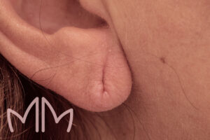 Tratamento de Lobuloplastia (Orelha Rasgada) em Santo Antônio da Platina e região. Dra. Mariana Magalhães Dermatologista