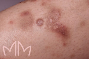 Tratamento Lúpus Cutâneo em Santo Antônio da Platina e região. Dra. Mariana Magalhães Dermatologista