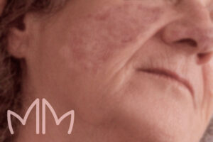 Tratamento de Lúpus Eritematoso Cutâneo Crônico em Santo Antônio da Platina e região. Dra. Mariana Magalhães Dermatologista