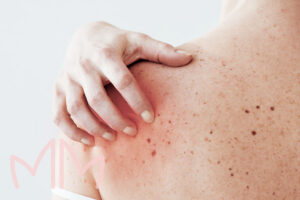 Tratamento de Fogo Selvagem (Pênfigo) em Santo Antônio da Platina e região. Dra. Mariana Magalhães Dermatologista