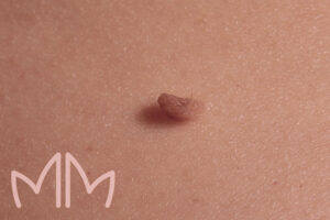 Tratamento de Pintas e Verrugas em Santo Antônio da Platina e região. Dra. Mariana Magalhães Dermatologista