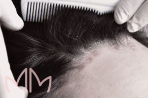 Tratamento de Psoríase couro cabeludo em Santo Antônio da Platina e região. Dra. Mariana Magalhães Dermatologista