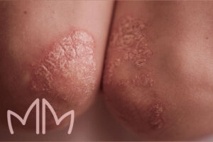 Tratamento de Psoríase em Santo Antônio da Platina e região. Dra. Mariana Magalhães Dermatologista