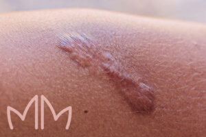 Tratamento de Queloide em Santo Antônio da Platina e região. Dra. Mariana Magalhães Dermatologista