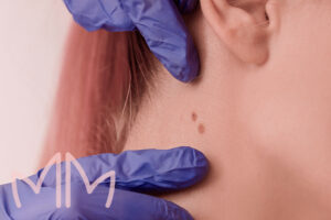 Procedimento de Remoção CA pele em Santo Antônio da Platina e região. Dra. Mariana Magalhães Dermatologista