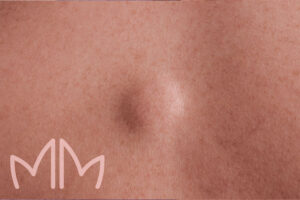 Procedimento de Retirada de pintas, verrugas, cistos ou lipomas em Santo Antônio da Platina e região. Dra. Mariana Magalhães Dermatologista