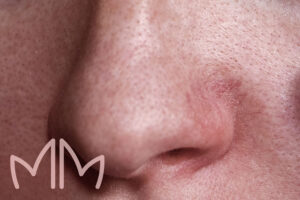 Tratamento Rosácea em Santo Antônio da Platina e região. Dra. Mariana Magalhães Dermatologista