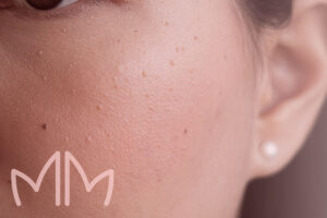 Tratamento de Siringoma em Santo Antônio da Platina e região. Dra. Mariana Magalhães Dermatologista