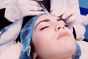 Aplicação de Toxina Botulínica em Santo Antônio da Platina e região. Dra. Mariana Magalhães Dermatologista