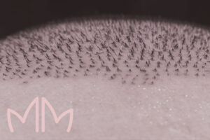 Transplante Capilar - Técnica FUE em Santo Antônio da Platina e região. Dra. Mariana Magalhães Dermatologista