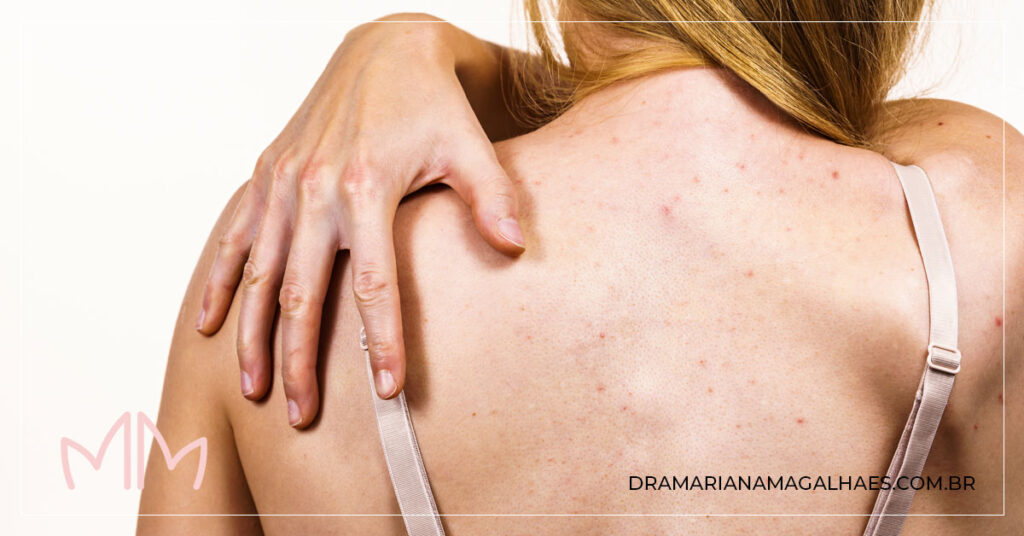 Mulher adulta com acne na parte superior das costas.